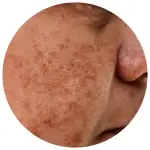 Melasma